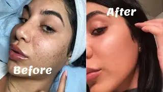 IPL PHOTOFACIAL | احسن علاج لتصبغات البشرة | بالليزر