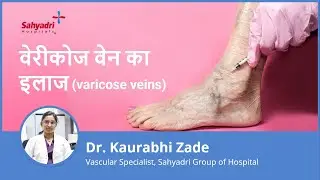 वेरीकोज वेन का इलाज | Varicose Veins in Hindi | varicose veins ka ilaj | Dr. Kaurabhi Zade ,Sahyadri