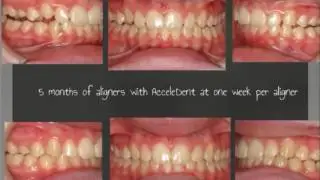 Dr. Sonia Palleck Minimizing Aligner Tracking Issues With AcceleDent