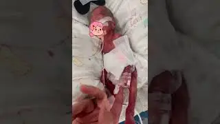 Premature baby during Treatment  #prematurebaby #newbornarrival #cute #prematurebirth #baby