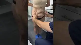 Pre-Op Marking For Panniculectomy Surgery