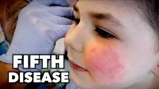 FIFTH DISEASE (Extremely Contagious) | Dr. Paul