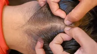 ASMR - Most Relaxing Scalp Check Compilation, Lice Check, Scratching & Hair Pulling For Deep Sleep 🌿