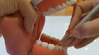 LR Distobuccal and Mesiobuccal #29 UC