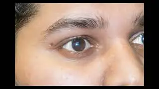 Scleral Contact Lens in Bangladesh. ( Age: 8 years)