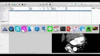 Basic 3D from OsiriX