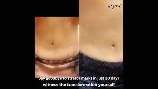 ✨30-Day Scar Transformation | Real Results #BeforeAndAfter#At first