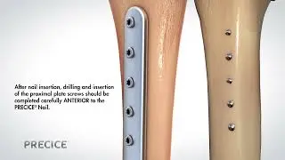 Precice&trade; Plate Assisted Bone Segment Transport (PABST)