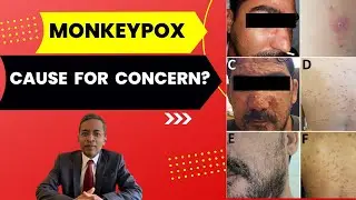Should we be concerned about Monkeypox - Consultant Dermatologist explains