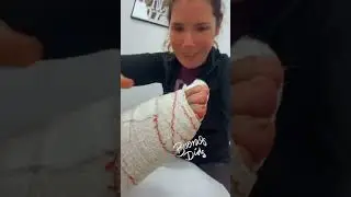 Empezamos el d&iacute;a Hallux Valgus | Juanete #vlog #fisio #vlogger #fisioterapia