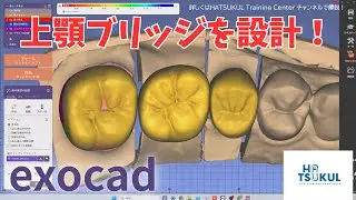#274　exocad設計　上顎ブリッジを設計！（解説なし版）