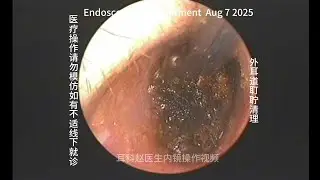 Routine cerumen impaction cleaning of the external auditory canal 20250807
