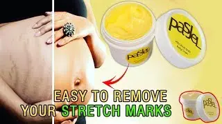 😍Remove Stretch Marks Easily😍 - TheEliteTrends