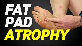 Атрофия жировой ткани &ndash; атрофия пяточной кости и атрофия подушечки стопы