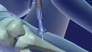 Intraosseous Infusion