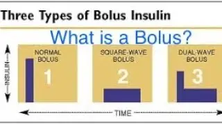 Medtronic Insulin Pump Questions - Bolus