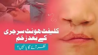 Will the Scar Show? Managing Scars After Cleft Lip Surgery | Dr. Ghulam Qadir Fayyaz