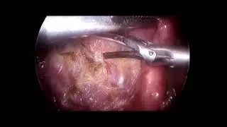 LAP CHOLE   video number 11 teaching surgery post garaduate students