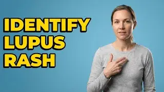 What Does the Lupus Malar Rash Look Like?