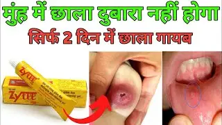 Zytee L Gel क्या है? Mouth Ulcer Gel Uses, Dose, Side Effects | Full Hindi Review