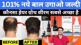 Wishcare Hair Growth Serum Review | Bare Anatomy Hair Growth Serum | Best Hair Growth Serum