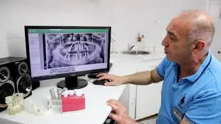 Системы имплантации All-on-4, All-on-6