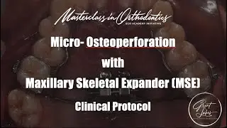 Micro-Osteoperforation with Maxillary Skeletal Expander | MSE | Jaw Expansion | Clinical Protocol