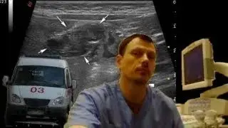 Pediatric Abdominal ultrasound - Upper Intestinal obstruction, gallbladder wall thickening