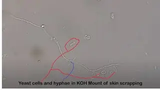 Yeast cells and hyphae in KOH Mount of skin scrapping