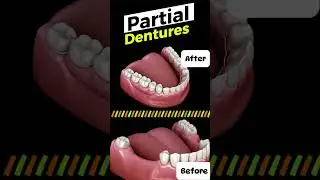 Partial Dentures: A Simple Fix for Missing Teeth
