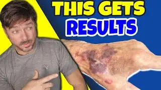 Miraculous Oil STOPS Purple Bruising on Aging Skin | Chris Gibson