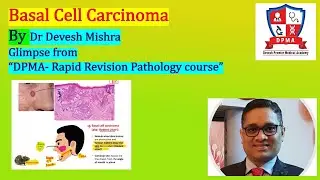 Basal Cell Carcinoma By Dr Devesh Mishra:- Glimpse from &ldquo;DPMA- Rapid Revision Pathology course&rdquo;.