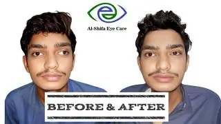 SquintBhengapan 40 Degree Squint Correction Surgery in Pakistan