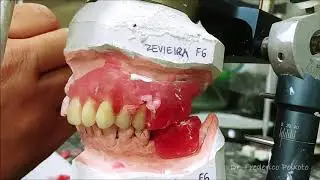 Sequência de montagem de dentes para Prótese Imediata
