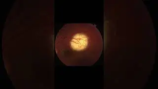 Injection alternatives for helioid unifocal idiopathic choroiditis?