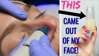 Getting My Pores SUCKED CLEAN! My First Hydra Facial Experience