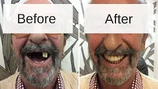 Dental treatment abroad ? Implants in Hungary