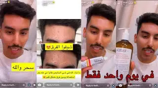 سنابات كويلي | كريم أزال كل الحبوب من وجه كويلي في يوم واحد