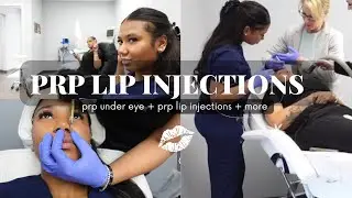 PRP LIP INJECTIONS &  PRP UNDER EYE CIRCLES