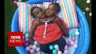 What is the future for these conjoined twins? - BBC News