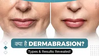 Dermabrasion Treatment For Acne Scars - It's Procedure, Types, Results, Before & After In Hindi