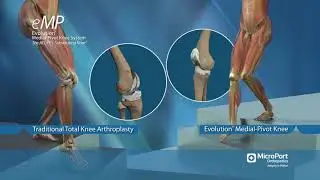 Stair Descent Animation Medial Pivot Knee vs Traditional TKR Designs