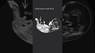 Unlocking the Mystery Identifying Your Baby's Gender Through Ultrasound #shortsfeed #mother #gender