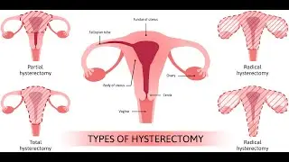 Hysterectomy after cesarean CPT code - simplify medical coding