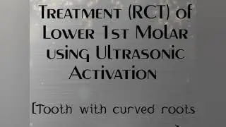 RCT of Lower 1st Molar using #Ultrasonic Activation #