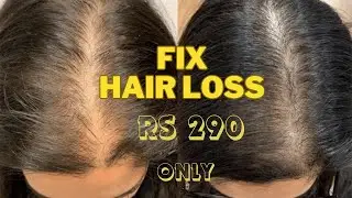 Regrow hair in a month with Derma Roller | 100% Working Method | Hair fall solution