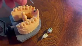 Angulated Screw Channel Custom Abutment for Neodent