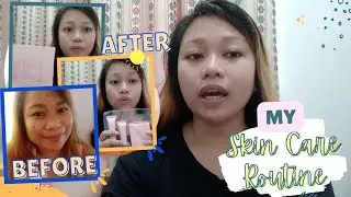 FAIRY SKIN DERMA SET PRODUCT REVIEW | SO EFFECTIVE SKINCARE | MY SKINCARE ROUTINE BY JOYCE