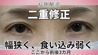 二重修正　二重幅狭く、くいこみ弱く。手術後３カ月の症例／名古屋こいずみ形成クリニック