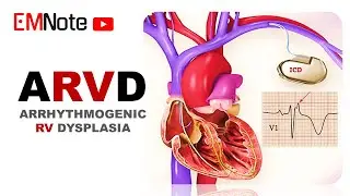 Arrhythmogenic Right Ventricular Dysplasia (ARVD)